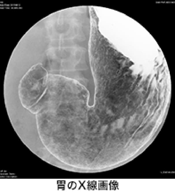 胃のX線画像