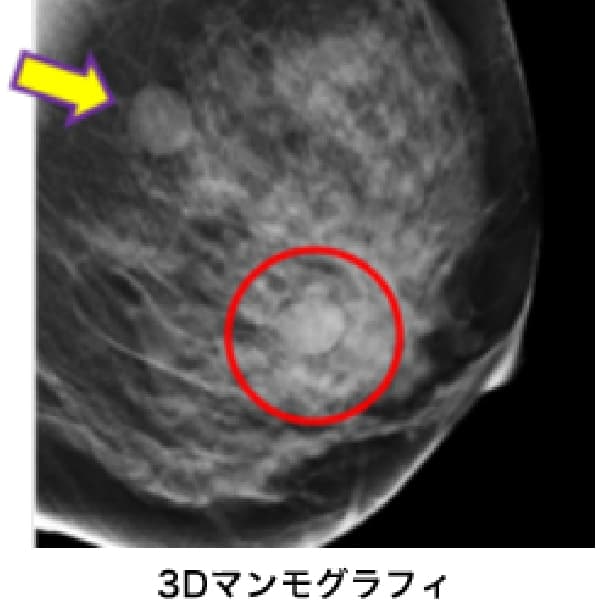 3Dマンモグラフィーの写真