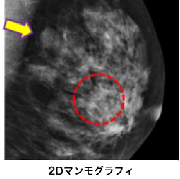 2Dマンモグラフィーの写真