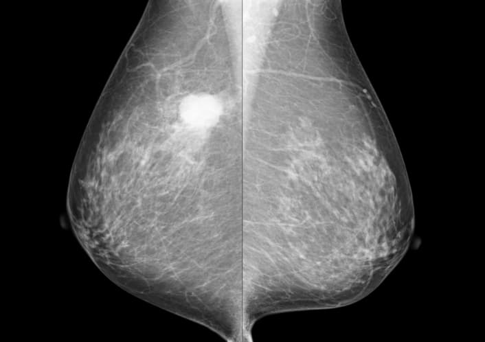 乳房X線画像